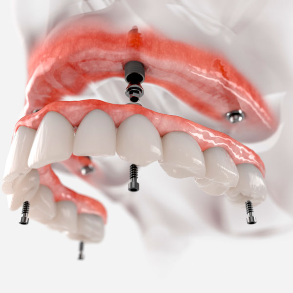 Implantes Dentales / Dra Cristina Santa