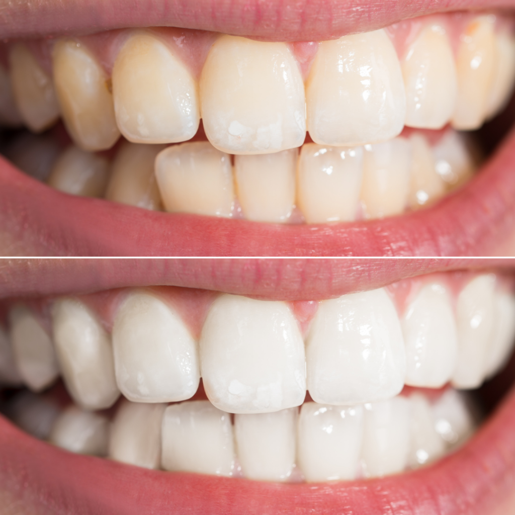 Blanqueamiento dental / Dra Cristina Santa