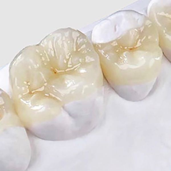 Incrustaciones dentales / Dra Cristina Santa